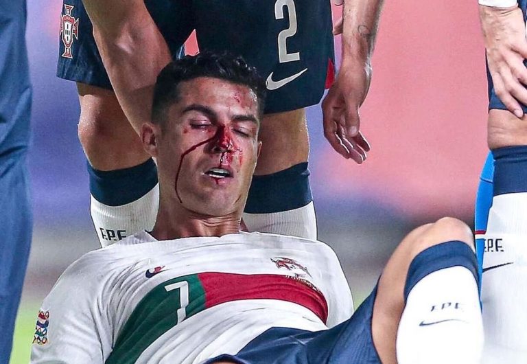 (VIDEO) Con sangre en el rostro: Cristiano Ronaldo y su fuerte golpe