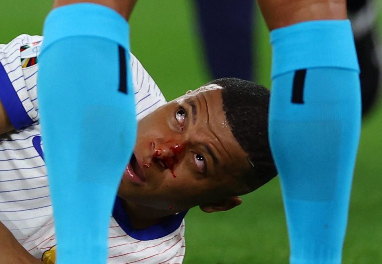 (VIDEO) ¡SANGRE EN LA NARIZ DE MBAPPÉ! Salió del campo por un fuerte choque