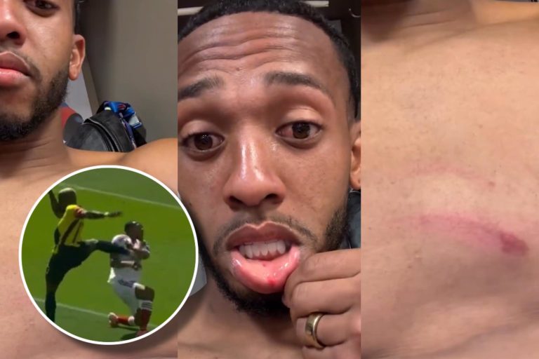 (VIDEO) Así quedó el jugador de Venezuela que recibió el ‘planchazo’ de Enner Valencia